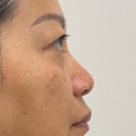 Non-Surgical Rhinoplasty Before & After Patient #3580