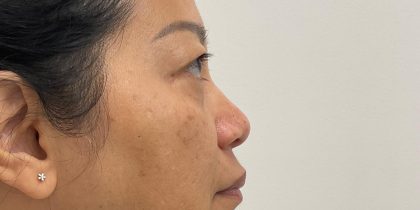 Non-Surgical Rhinoplasty Before & After Patient #3580