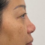 Non-Surgical Rhinoplasty Before & After Patient #3580