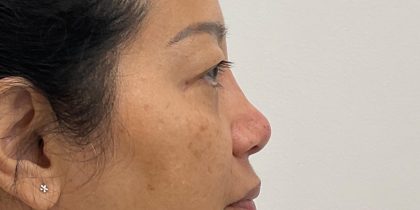 Non-Surgical Rhinoplasty Before & After Patient #3580