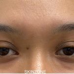 Mole Removal Before & After Patient #3572