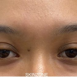 Mole Removal Before & After Patient #3572