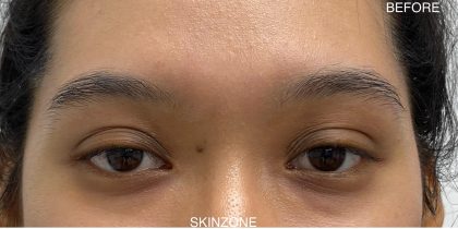 Mole Removal Before & After Patient #3572