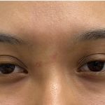 Mole Removal Before & After Patient #3572
