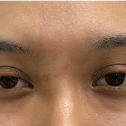 Mole Removal Before & After Patient #3572