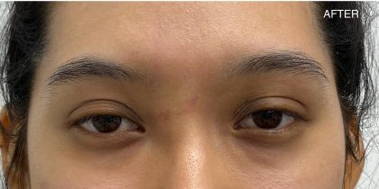 Mole Removal Before & After Patient #3572