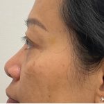 Non-Surgical Rhinoplasty Before & After Patient #3580