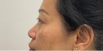 Non-Surgical Rhinoplasty Before & After Patient #3580