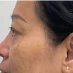 Non-Surgical Rhinoplasty Before & After Patient #3580
