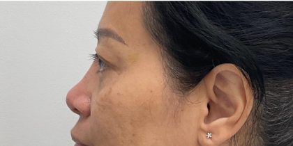 Non-Surgical Rhinoplasty Before & After Patient #3580