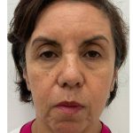 Skincredible 360 Before & After Patient #3567