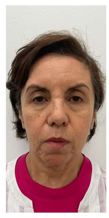 Skincredible 360 Before & After Patient #3567