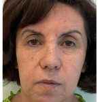 Skincredible 360 Before & After Patient #3567