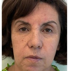 Skincredible 360 Before & After Patient #3567