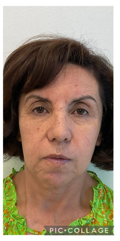 Skincredible 360 Before & After Patient #3567