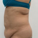 Liposuction Before & After Patient #3581