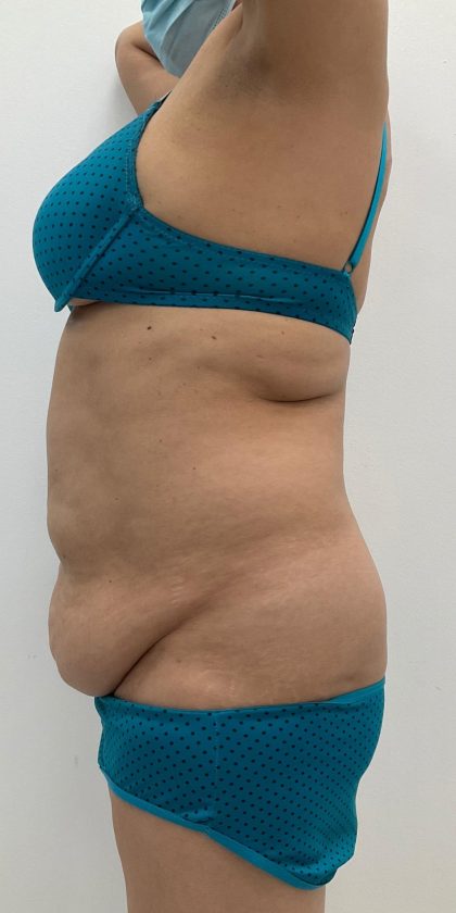 Liposuction Before & After Patient #3581