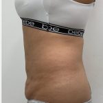 Liposuction Before & After Patient #3581