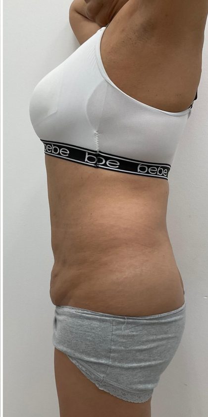 Liposuction Before & After Patient #3581