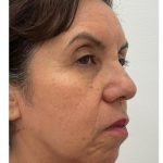 Skincredible 360 Before & After Patient #3567