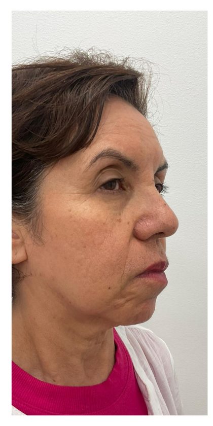 Skincredible 360 Before & After Patient #3567