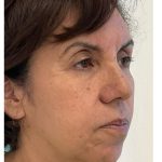Skincredible 360 Before & After Patient #3567