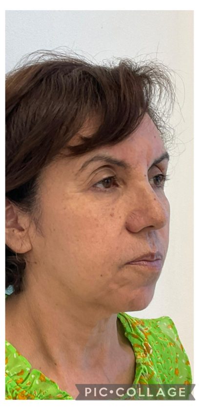 Skincredible 360 Before & After Patient #3567