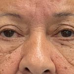 Blepharoplasty Before & After Patient #3589