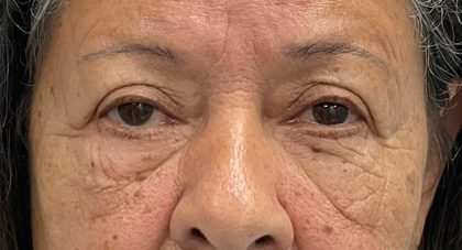 Blepharoplasty Before & After Patient #3589