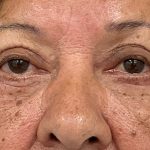 Blepharoplasty Before & After Patient #3589