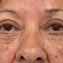 Blepharoplasty Before & After Patient #3589