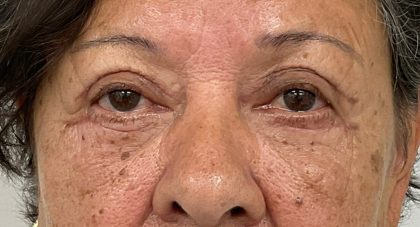 Blepharoplasty Before & After Patient #3589