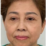 Facial Fillers Before & After Patient #3603