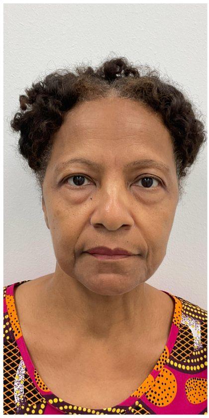 Lower Blepharoplasty Before & After Patient #3604