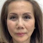 Under Eye Fillers Before & After Patient #3629