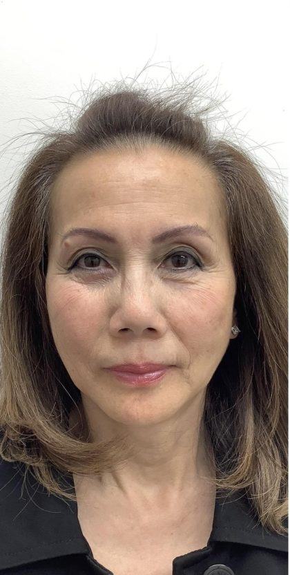 Under Eye Fillers Before & After Patient #3629