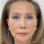 Under Eye Fillers Before & After Patient #3629