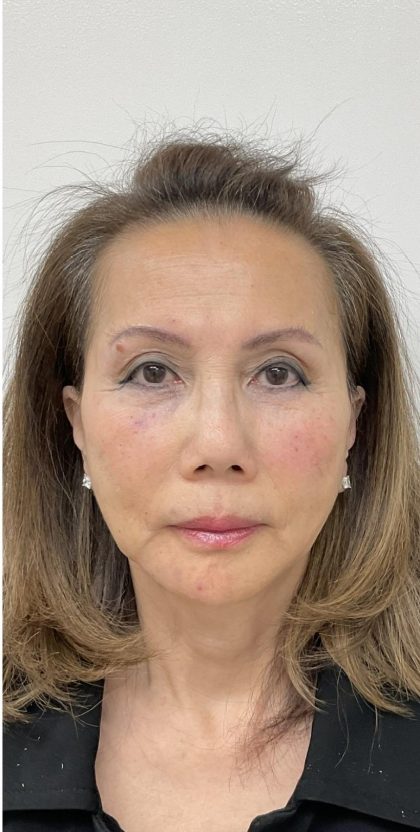 Under Eye Fillers Before & After Patient #3629