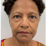 Blepharoplasty Before & After Patient #3630