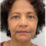 Blepharoplasty Before & After Patient #3630