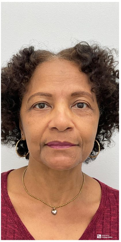 Blepharoplasty Before & After Patient #3630