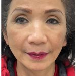 Full Face Enhancement (Botox + Filler Treatment) Before & After Patient #3631