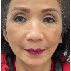 Full Face Enhancement (Botox + Filler Treatment) Before & After Patient #3631