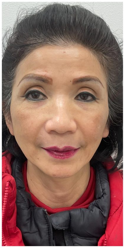 Full Face Enhancement (Botox + Filler Treatment) Before & After Patient #3631
