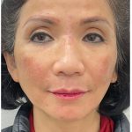 Full Face Enhancement (Botox + Filler Treatment) Before & After Patient #3631