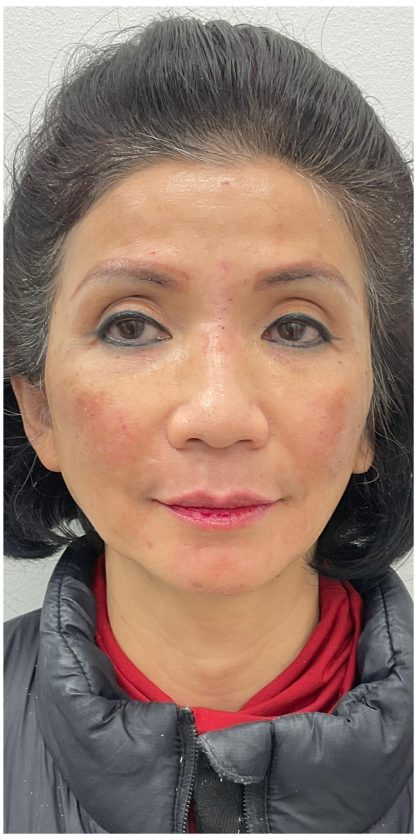 Full Face Enhancement (Botox + Filler Treatment) Before & After Patient #3631