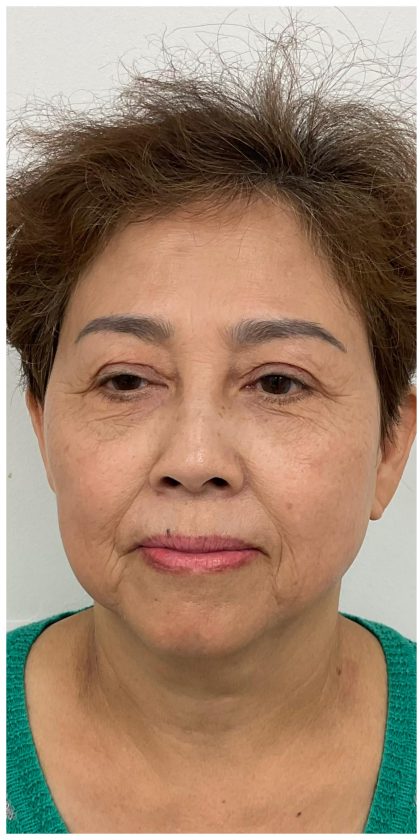 Full Face Enhancement (Botox + Filler Treatment) Before & After Patient #3632