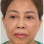 Full Face Enhancement (Botox + Filler Treatment) Before & After Patient #3632