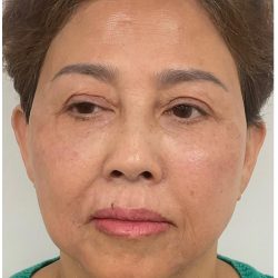 Full Face Enhancement (Botox + Filler Treatment) Before & After Patient #3632