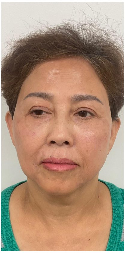 Full Face Enhancement (Botox + Filler Treatment) Before & After Patient #3632